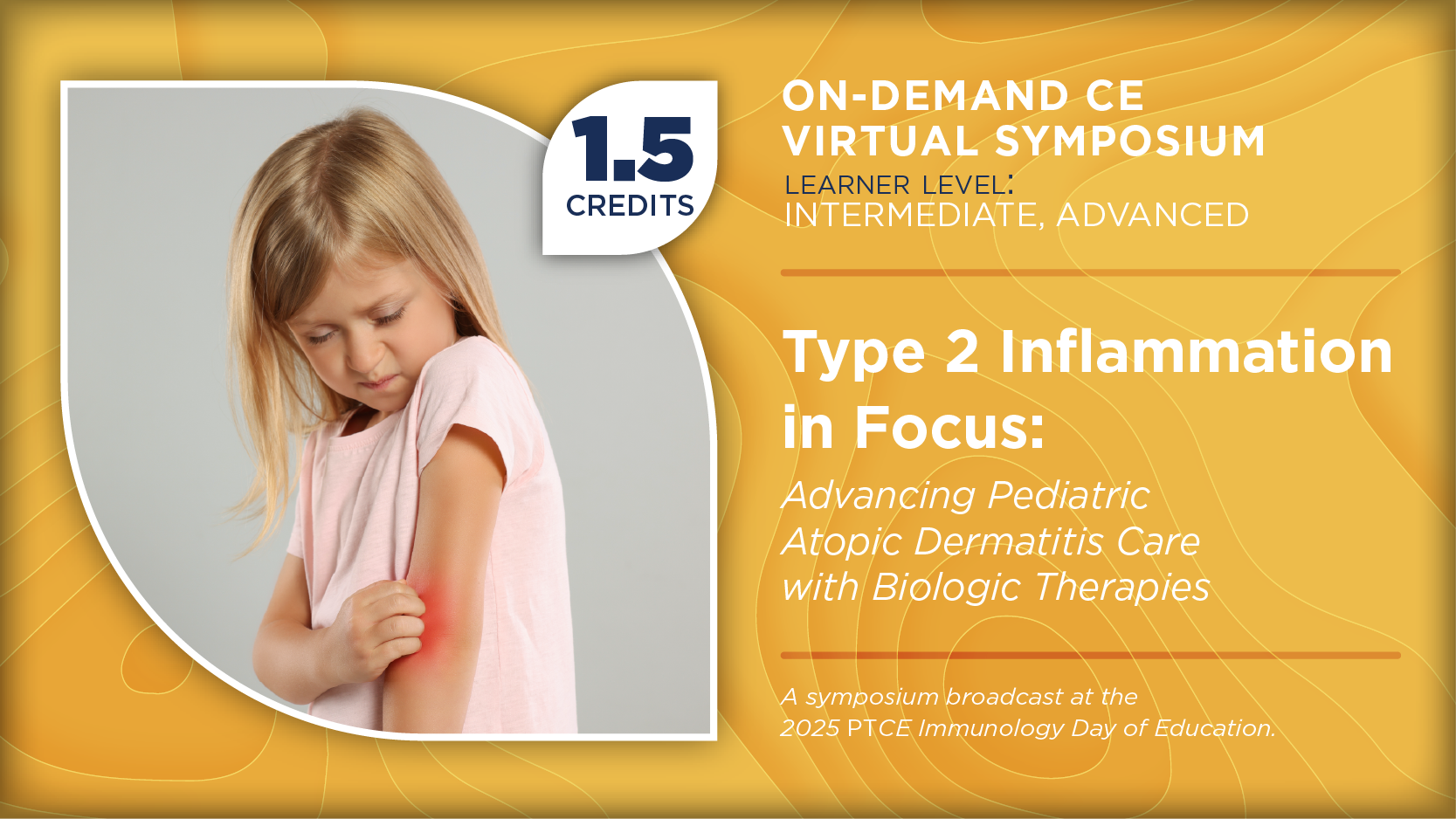 Type 2 Inflammation in Focus: Advancing Pediatric Atopic Dermatitis Care With Biologic Therapies