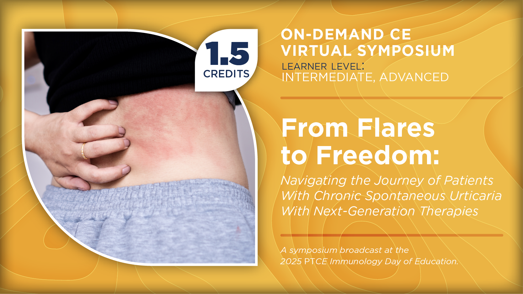 From Flares to Freedom: Navigating the Journey of Patients With Chronic Spontaneous Urticaria With Next-Generation Therapies